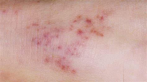 type of rash in meningitis